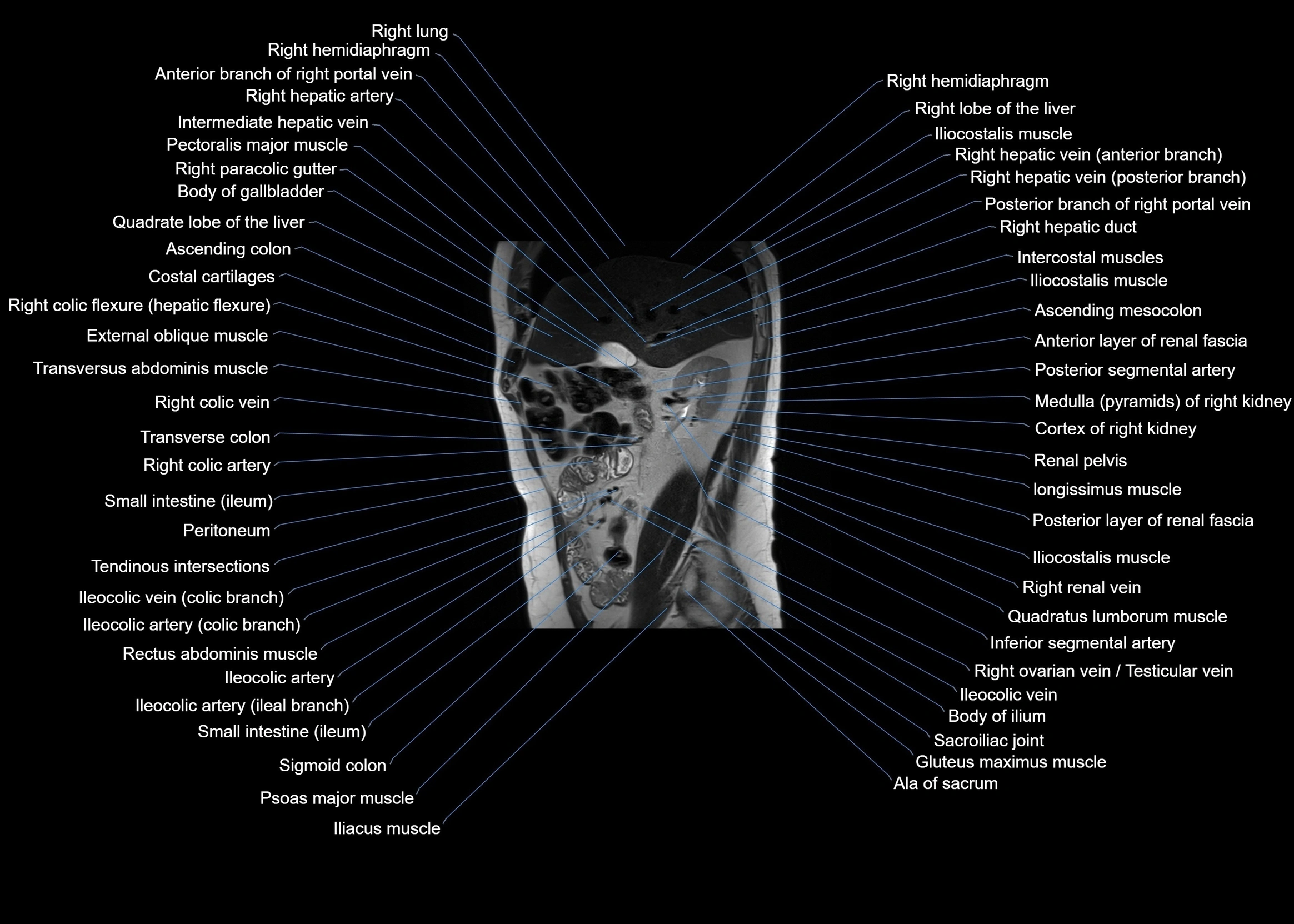 MRI abdomen sagittal cross sectional anatomy  radiology  image-img-00001-00026.webp